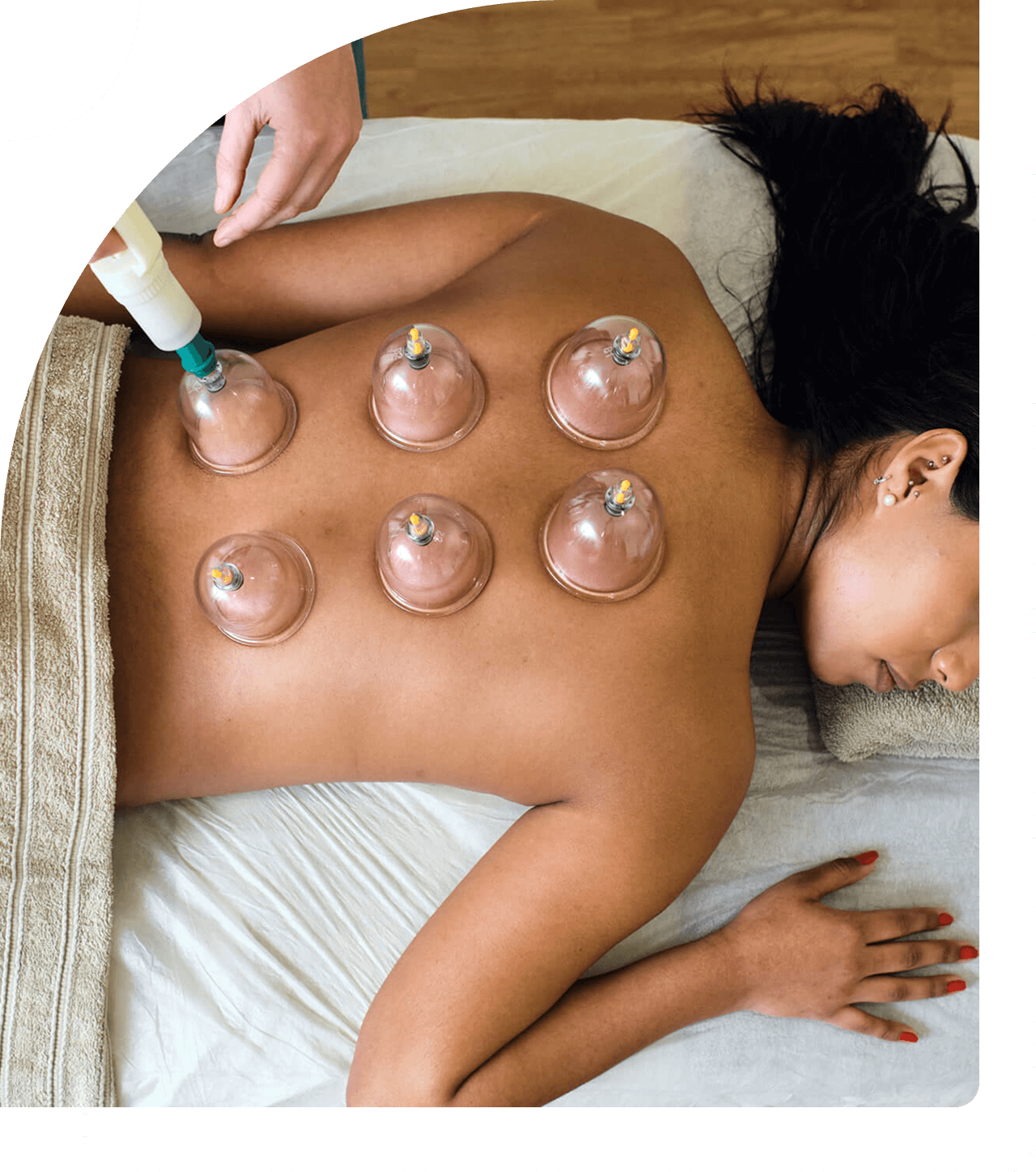 Woman receiving cupping therapy on her back.