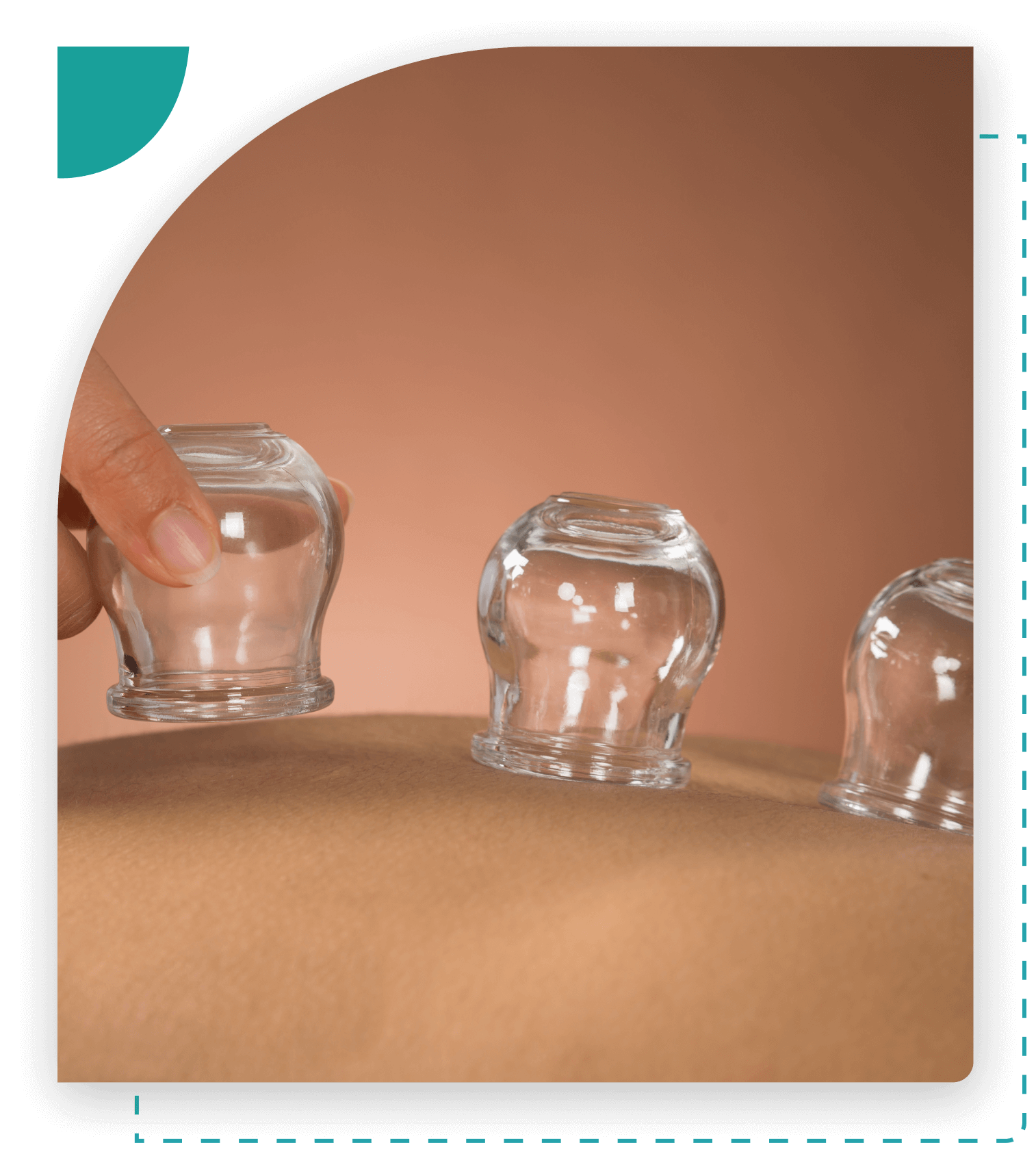 Glass cups on skin during cupping therapy.